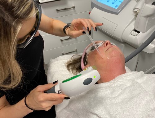 A laser handpiece over a patient’s skin, both wearing protective eyewear