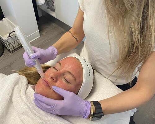A microneedling pen passing over a patient’s cheek